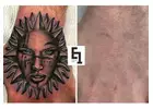 Tattoo removal services in Sydney