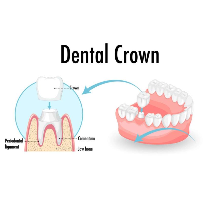 Restore Your Smile with Durable Dental Crowns