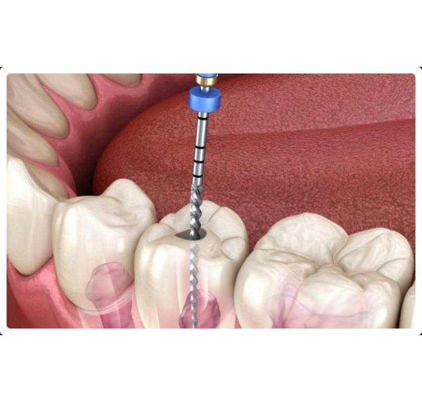 Expert Root Canal Melbourne Treatments