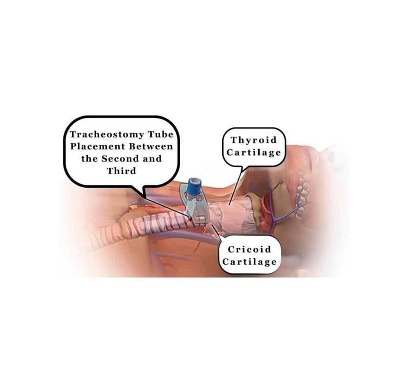 Tracheostomy Tube Change at Home – Safe, Sterile Procedure by Trained Nurses