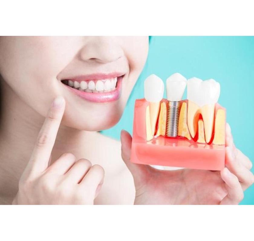 Are Dental Implants Covered by Insurance?