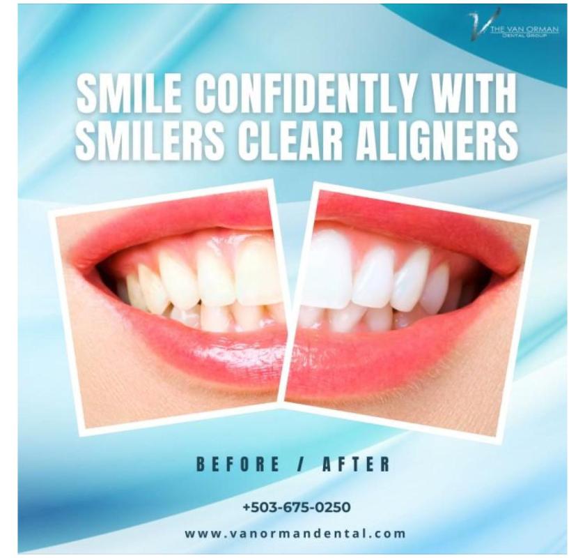  Are Smilers Clear Aligners Right for You ?