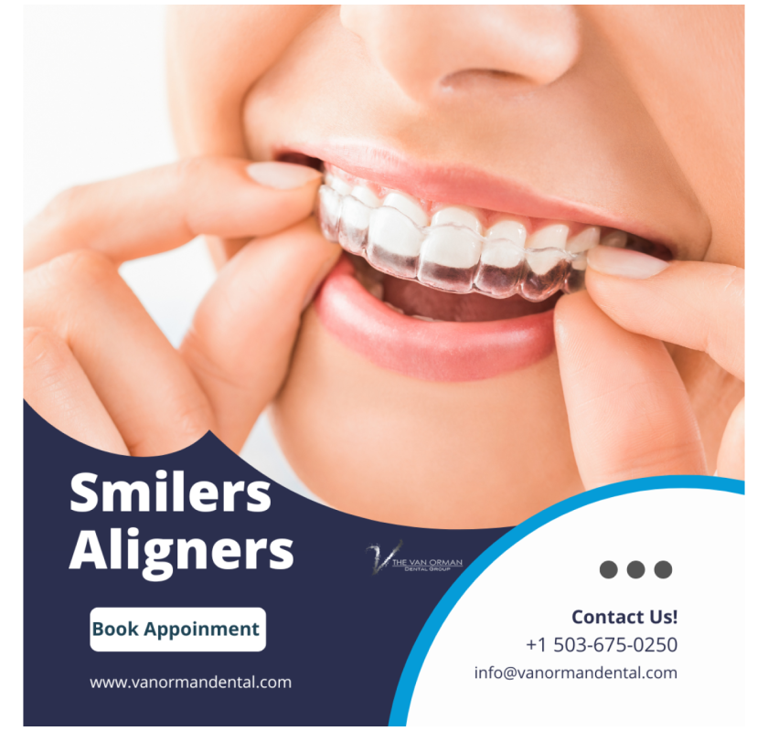 How Do Smilers Aligners Work?