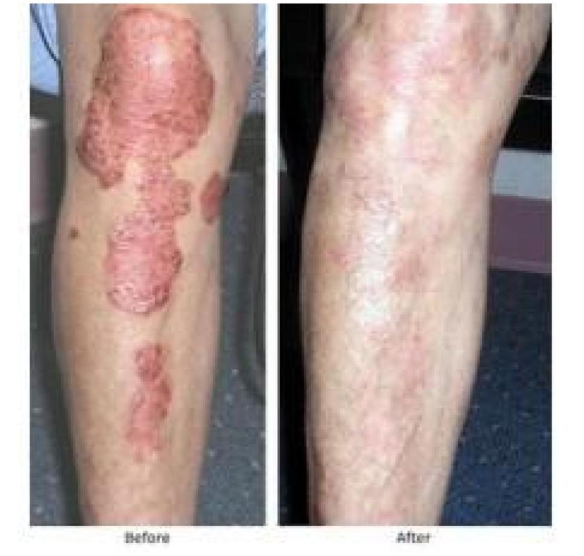 AROGYAM PURE HERBS KIT FOR PSORIASIS