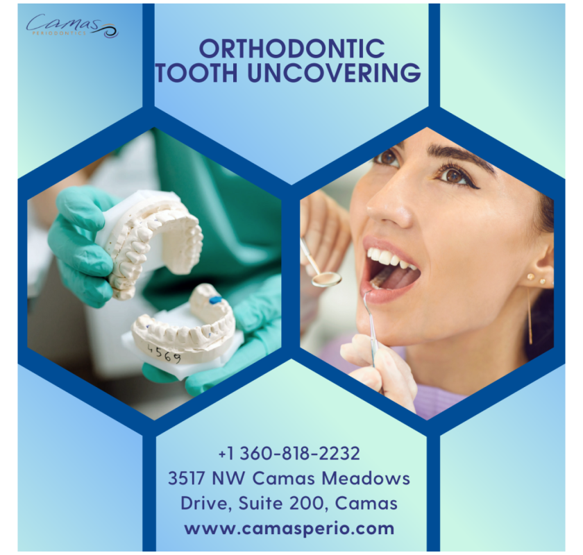 How Orthodontic Tooth Uncovering Helps Create a Perfect Smile ?
