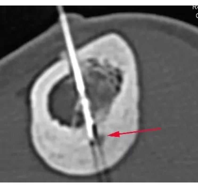 Radiofrequency Ablation (RFA) in Mumbai – Picture This Imaging 