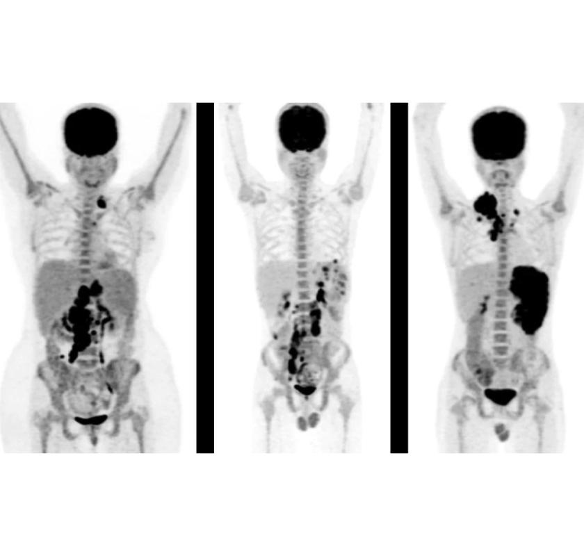 PET Scan in Mumbai – Picture This Imaging 