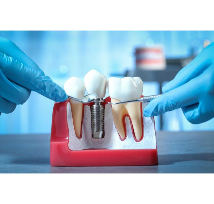 How Dental Implants Improve Oral Health in the Long Run?