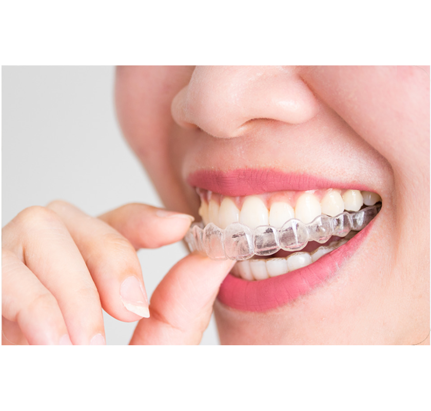 Invisible Braces Treatment – Discreet & Effective at The Smile Spa